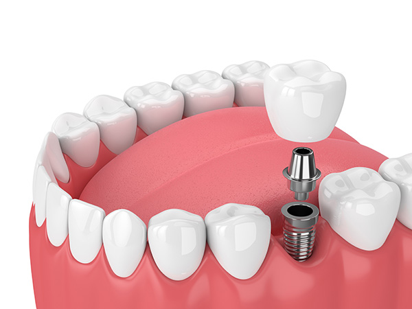 Dental Implants in North Georgia