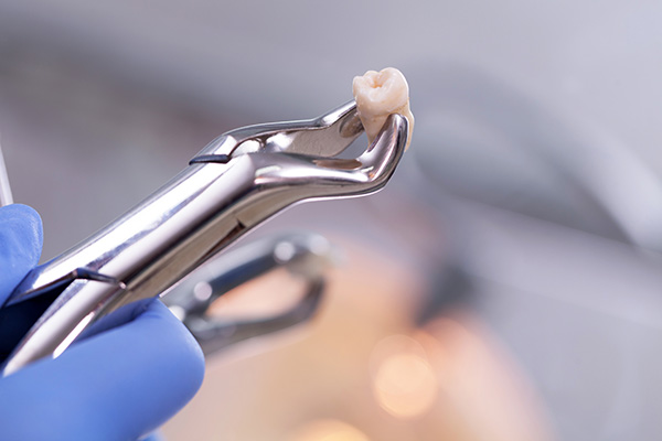 Dental Extractions in North Georgia