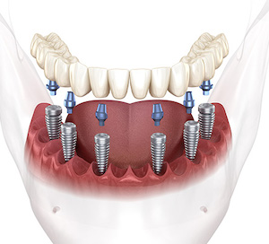 All-on-6 Dental Implants