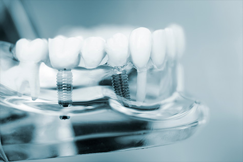 Zygomatic implants