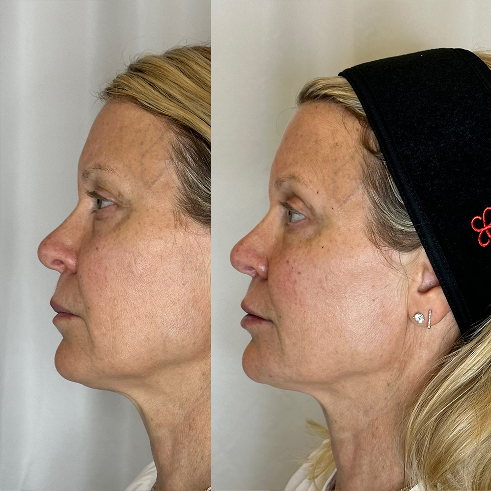 Before After Images