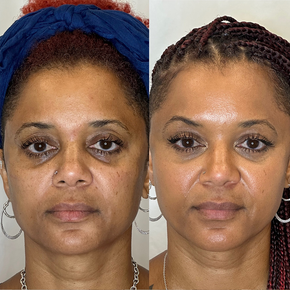 Before After Images
