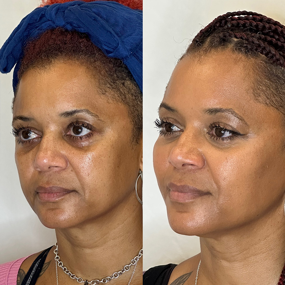 Before After Images