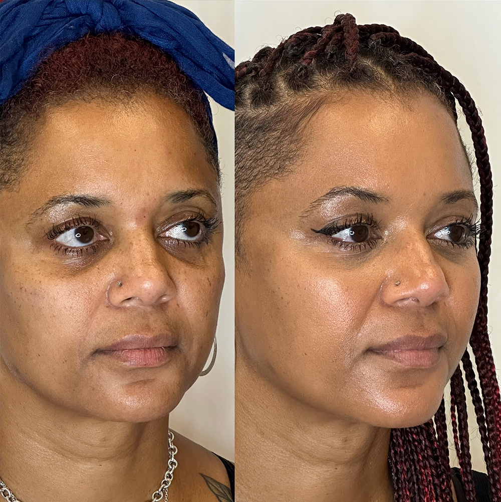 Before After Images