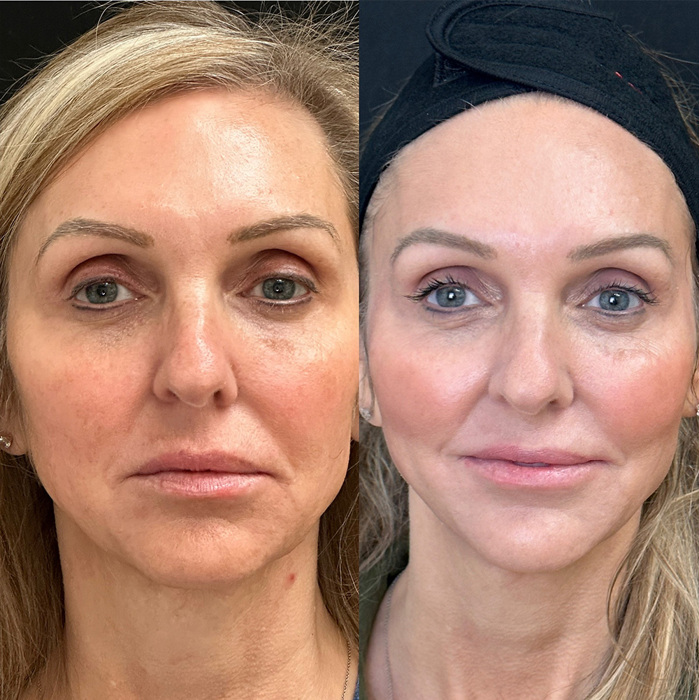 Before After Images