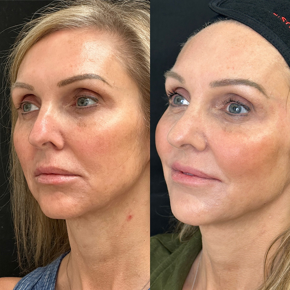 Before After Images