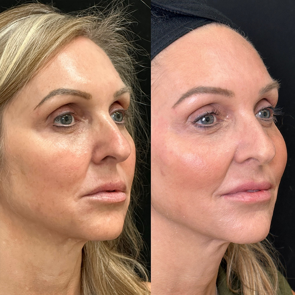 Before After Images