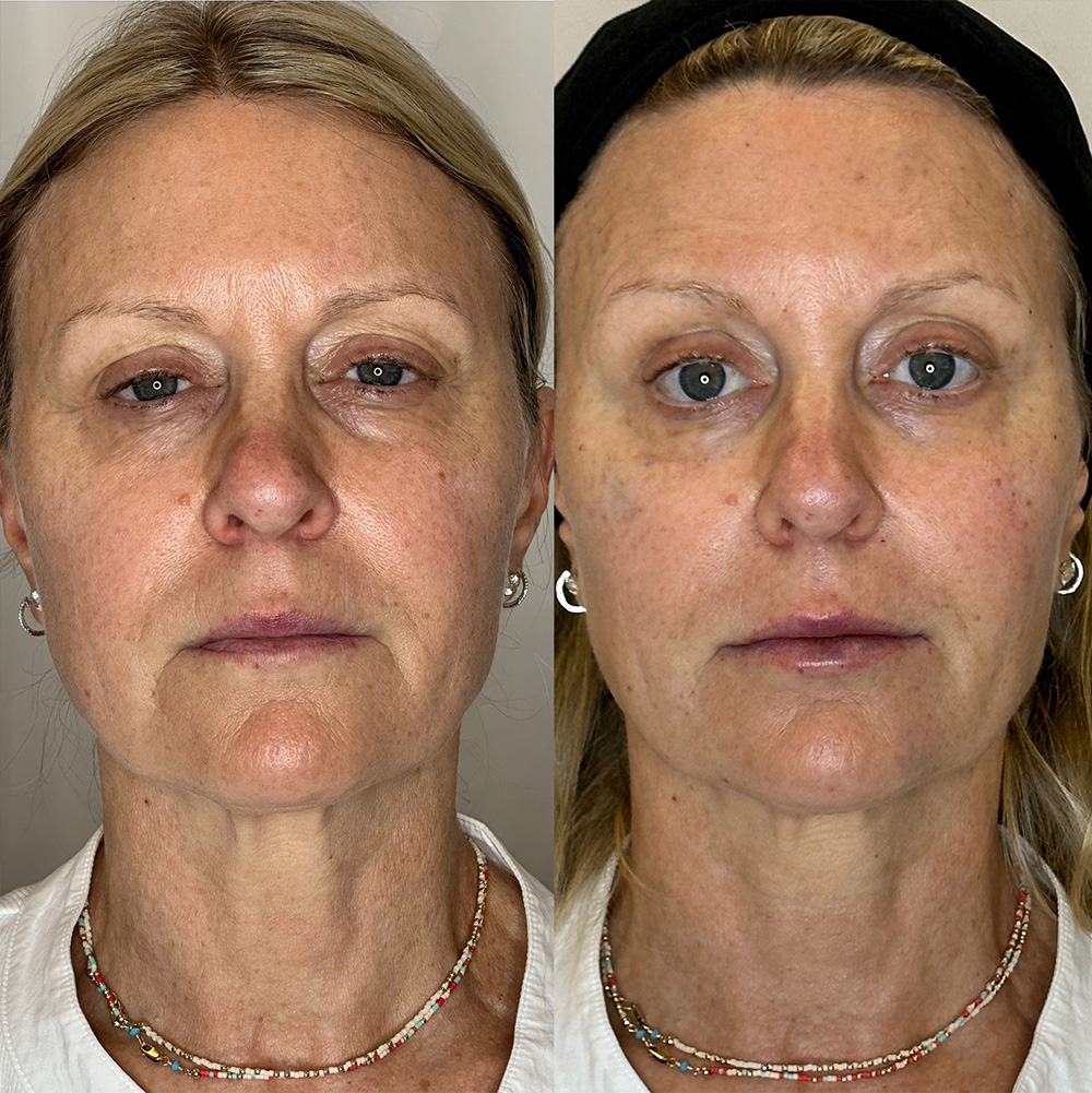 Before After Images