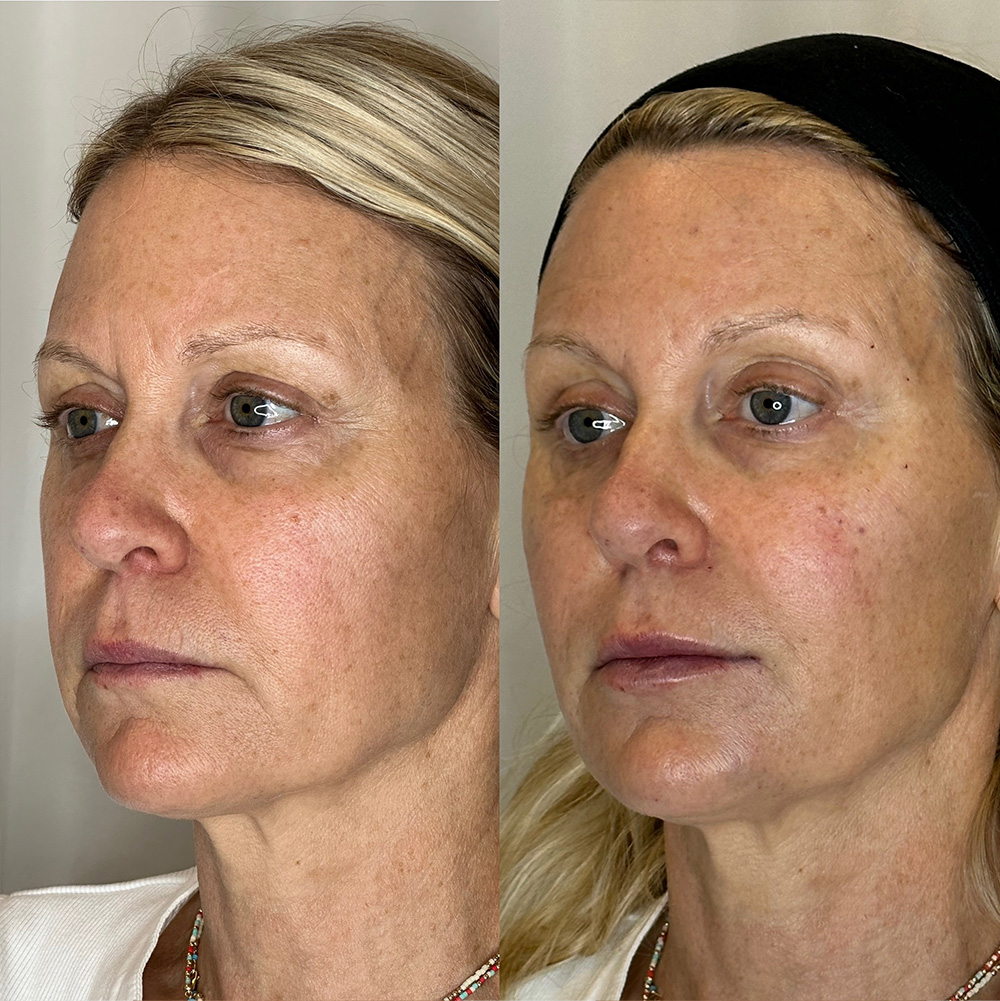 Before After Images