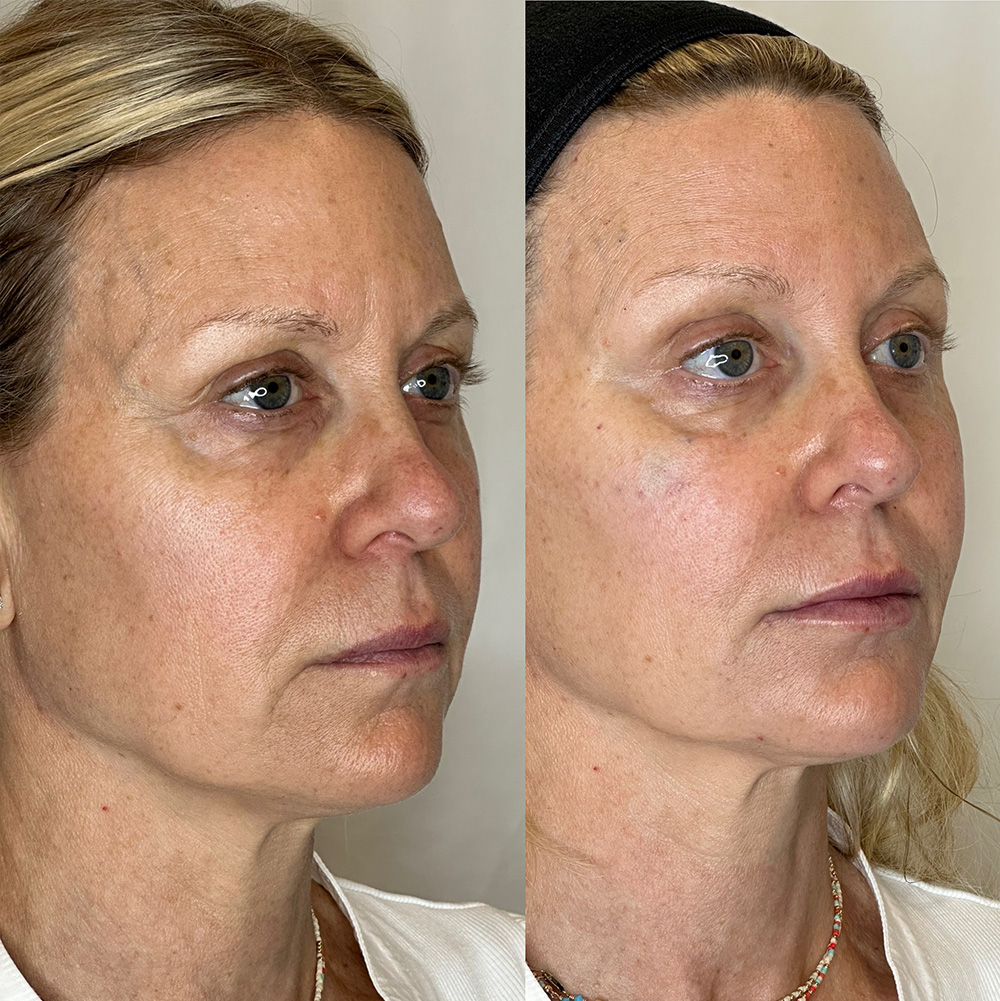 Before After Images