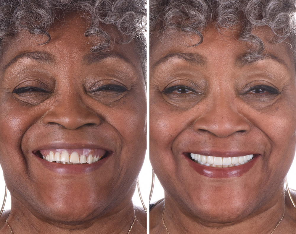 Real ANEWU patient, before and after dental implant treatment
