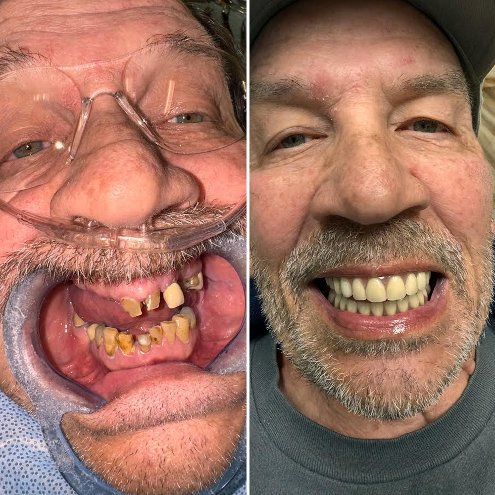 Real ANEWU patient, before and after dental implant treatment