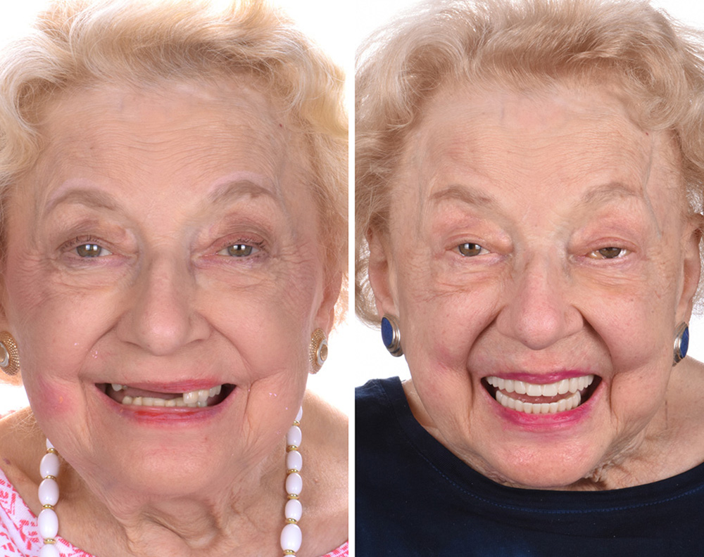 Real ANEWU patient, before and after dental implant treatment