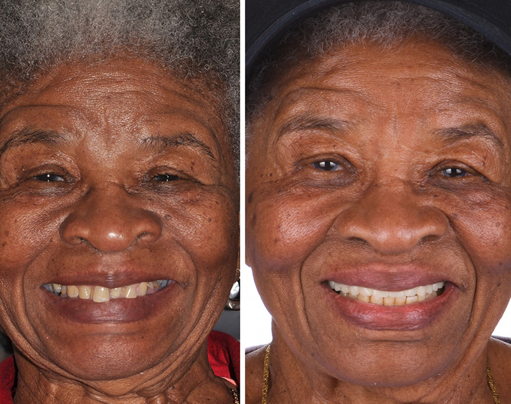 Real ANEWU patient, before and after dental implant treatment