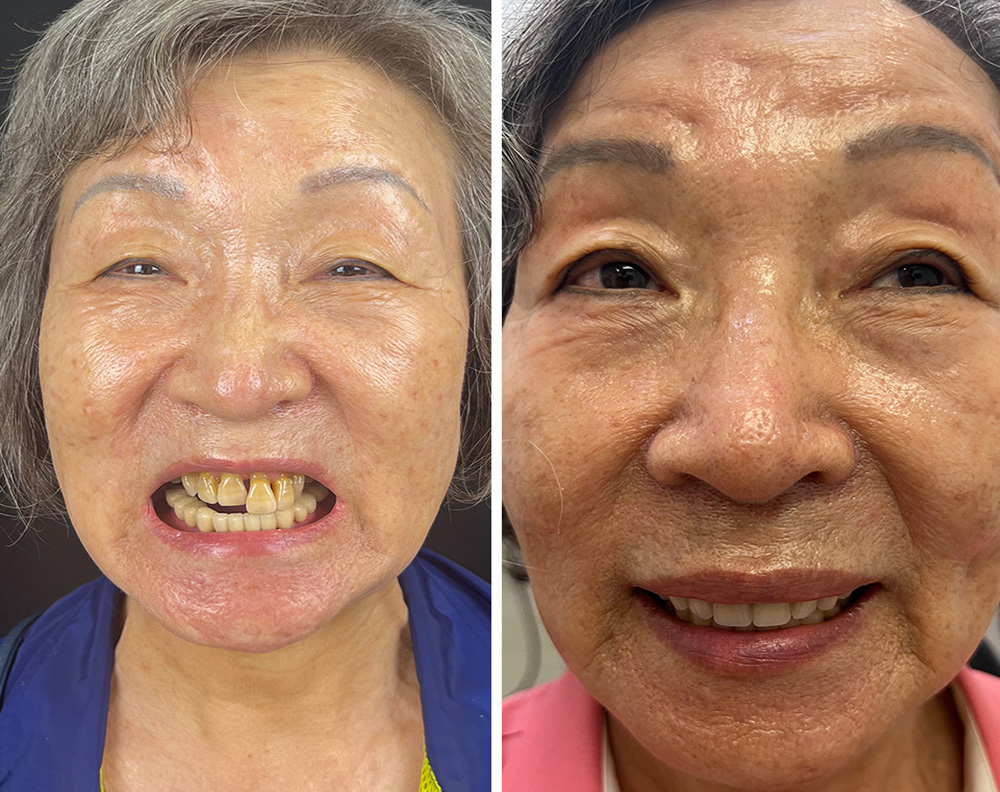 Real ANEWU patient, before and after dental implant treatment