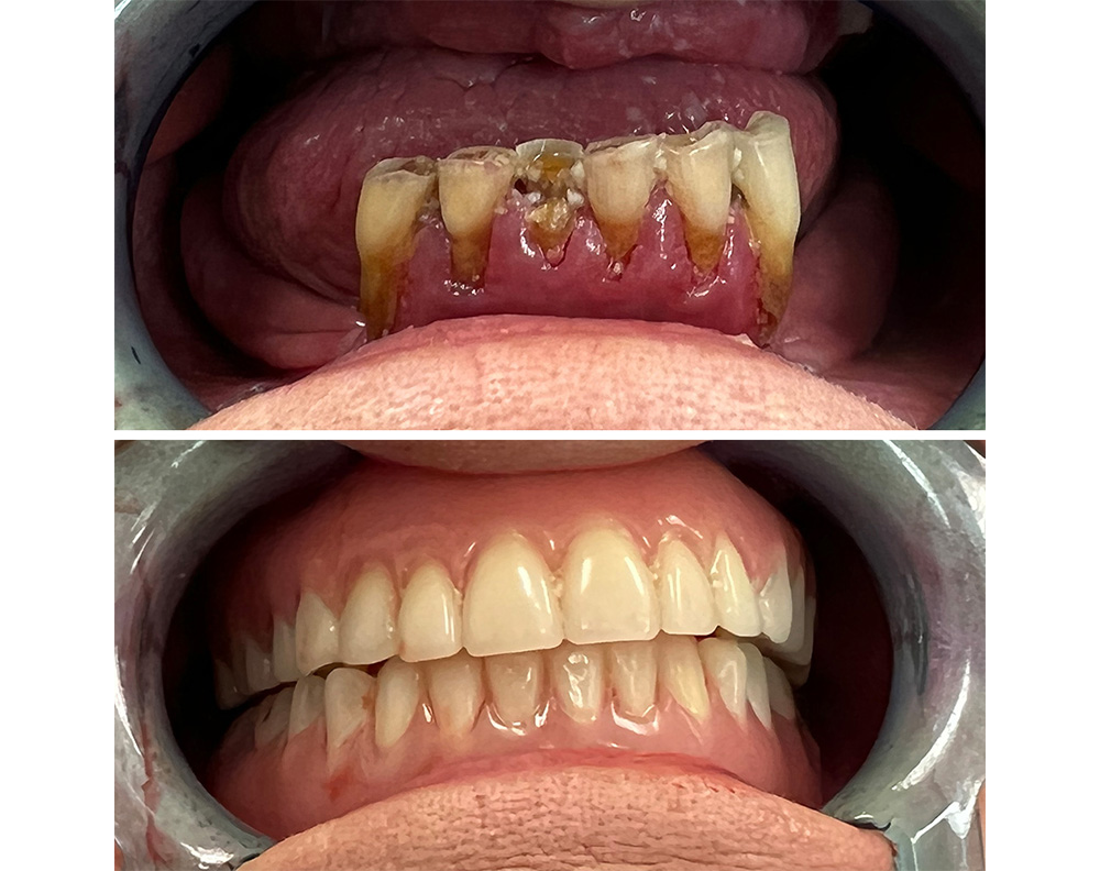 Real ANEWU patient, before and after dental implant treatment