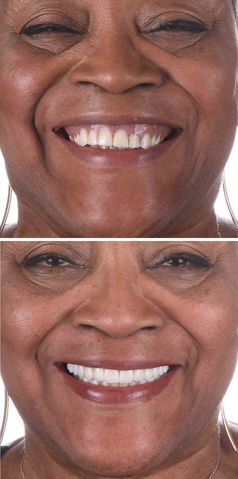 A real ANEWU patient's smile before and after All-On-4 dental implant treatment